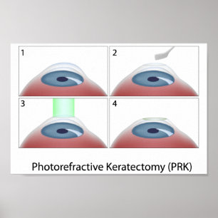 Póster Poster de queratectomía fotorefractiva (PRK)