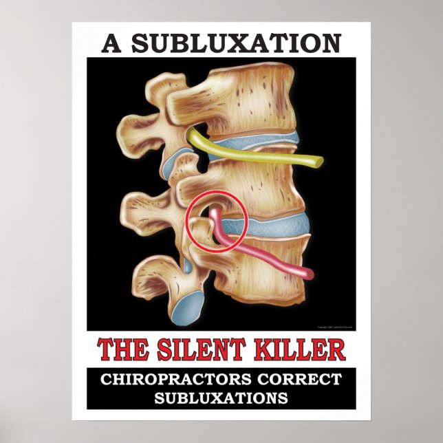 Póster Poster de subluxación vertebral quiropráctico (Frente)