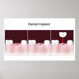Póster Poster del procedimiento de implante dental