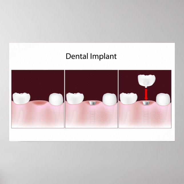 Póster Poster del procedimiento de implante dental (Frente)