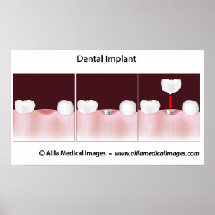 Póster Poster del procedimiento del implante dental