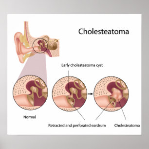 Póster Poster del tumor del oído medio del colesteatoma
