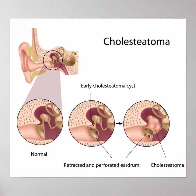 Póster Poster del tumor del oído medio del colesteatoma (Frente)