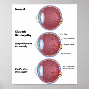Póster Poster diabético de la retinopatía de la