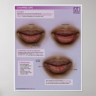 Póster Poster Médico de Lips con Champado Melalógico