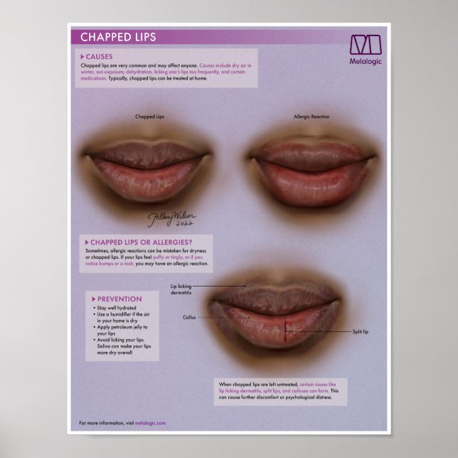 Póster Poster Médico de Lips con Champado Melalógico (Frente)