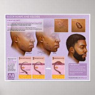 Póster Poster Médico de Paros de Razor Melalógico y Keloi