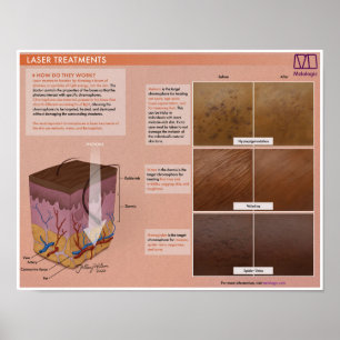 Póster Poster Médico de Tratamiento Láser Melalógico