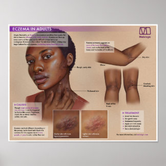 Póster Poster Médico Melalogic Eczema
