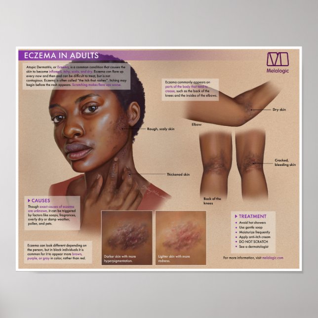 Póster Poster Médico Melalogic Eczema (Frente)