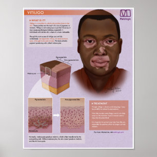 Póster Poster Médico Melalogic Vitiligo