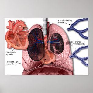 Póster Poster pulmonar de la hipertensión