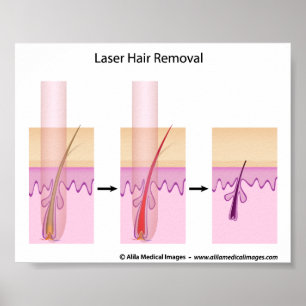Póster Procedimiento de retiro del pelo del laser