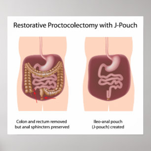 Póster Proctocolectomía restaurativa con j-pouch