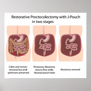 Póster Proctocolectomía restaurativa con j-pouch 2 etapas