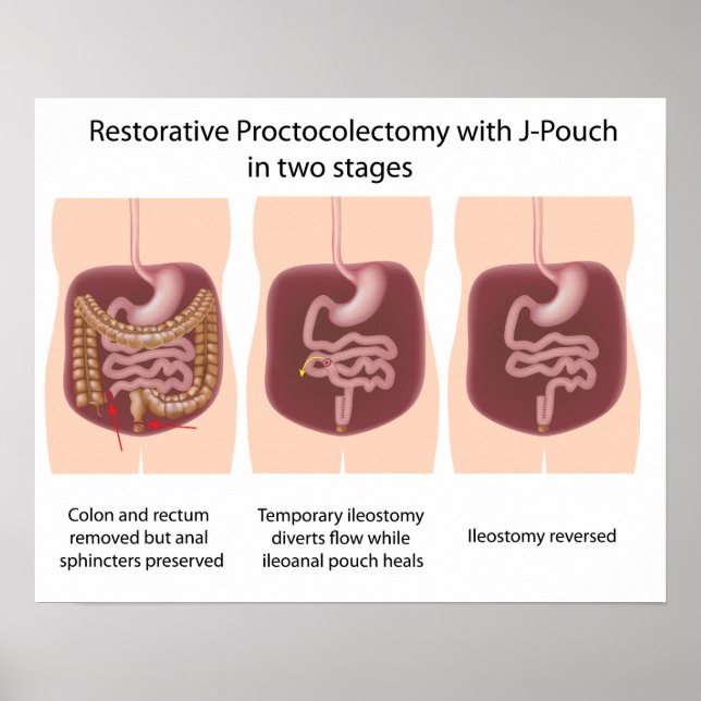 Póster Proctocolectomía restaurativa con j-pouch 2 etapas (Frente)
