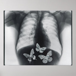Póster Radiografía de mariposas en el estómago