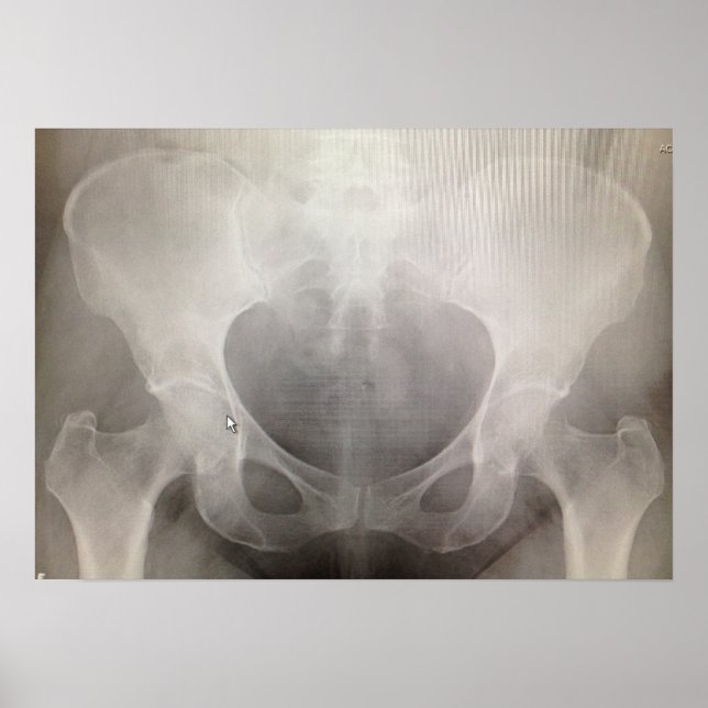 Póster Radiografía de Pelvis (Frente)