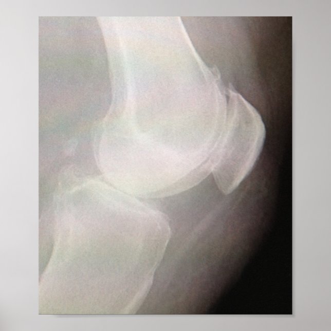Póster Rayo X de rodilla (Frente)