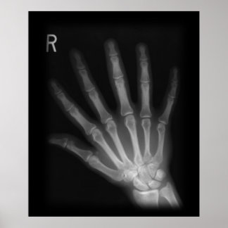 Póster Rayo X extra digital a mano derecha