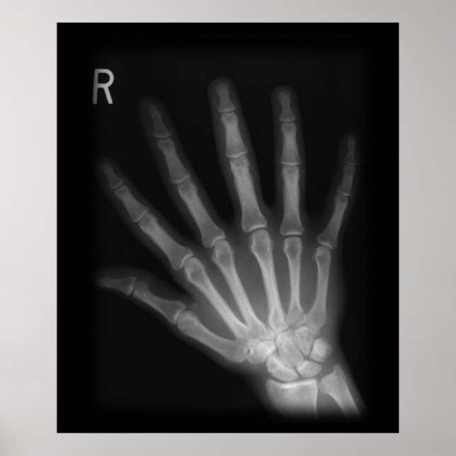 Póster Rayo X extra digital a mano derecha (Frente)