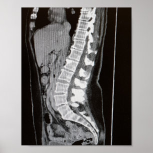 Póster RM de la columna vertebral