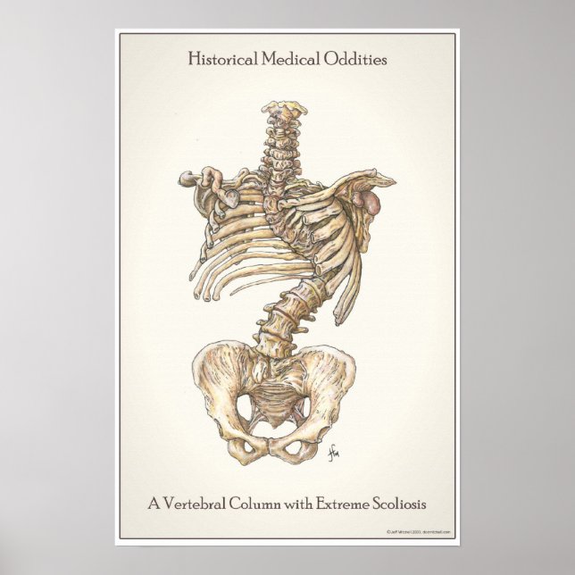 Póster Scoliosis Spina (Frente)