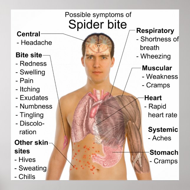 Póster Síntomas comunes en la tabla de picaduras de araña (Frente)