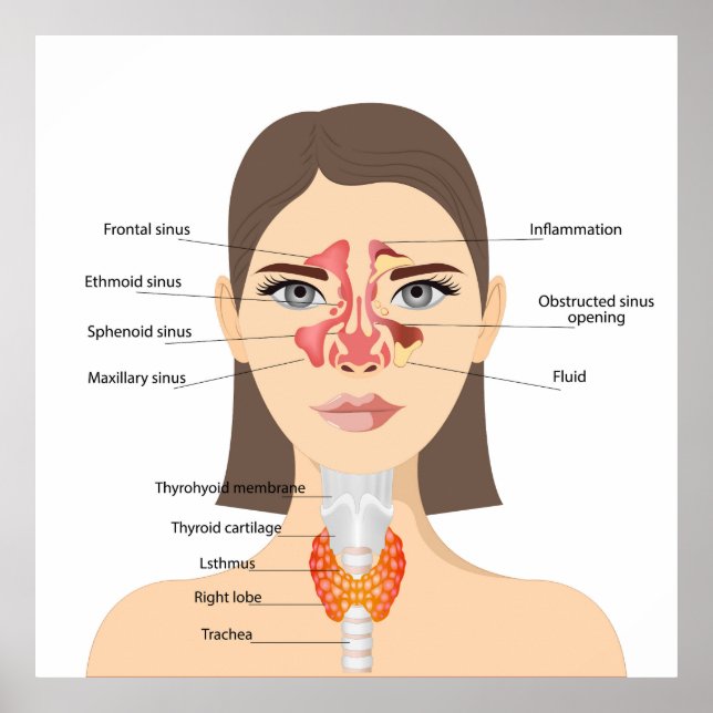 Póster Sinusitis (Frente)