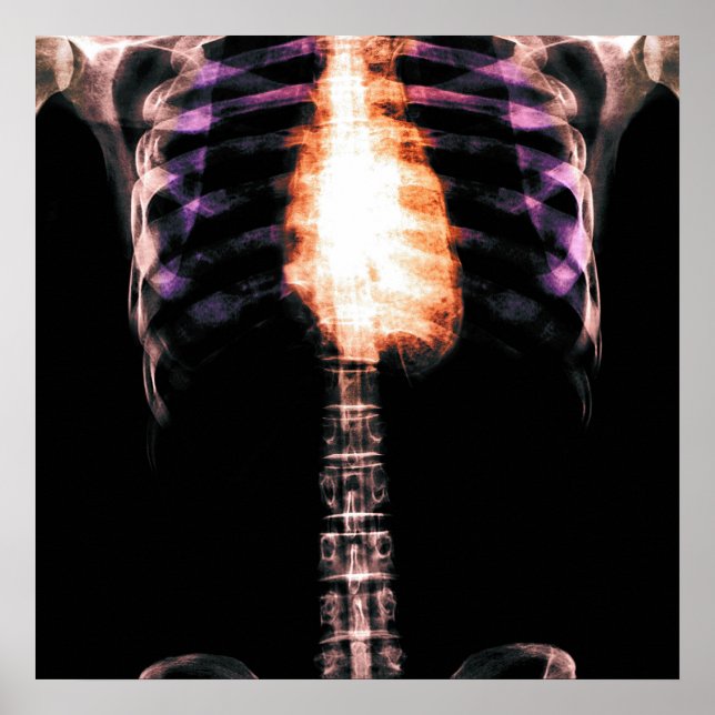 PÓSTER SKELETON TORSO RIBS DE RAY X - ORIGINAL (Frente)