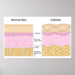 Póster Skin cellulite  Poster