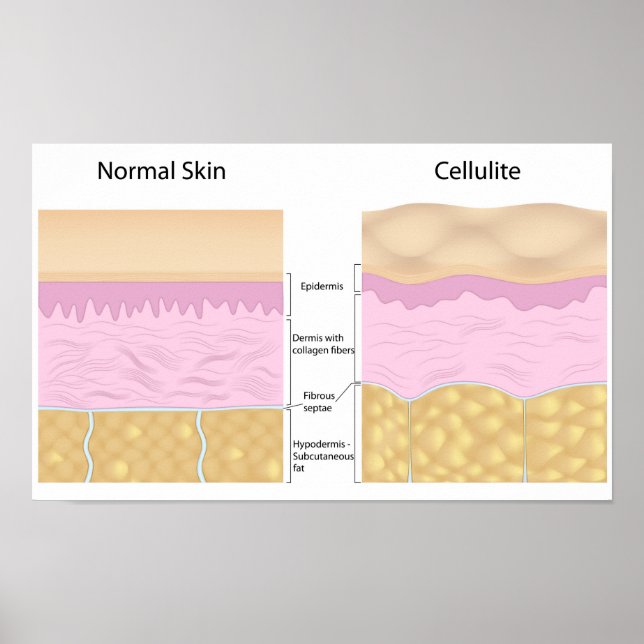Póster Skin cellulite  Poster (Frente)