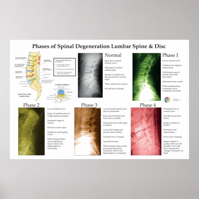 Póster Spinal Degeneration Lumbar Spine Chiropractic (Frente)