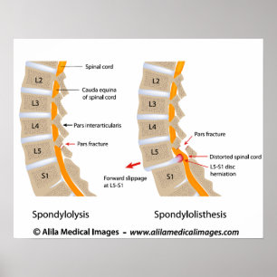 Póster Spondylolysis y spondylolisthesis, etiquetados
