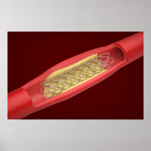 Póster Stent médico dentro del vaso sanguíneo