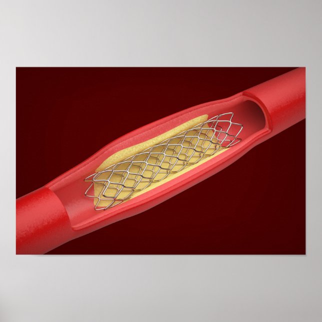 Póster Stent médico dentro del vaso sanguíneo (Frente)
