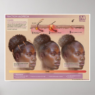 Póster Tracción Melalógica Poster médico Alopecia