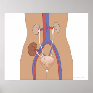 Póster Trasplante de riñón
