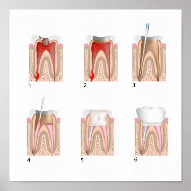 Póster Tratamiento del canal raíz Cualquier Poster de tam (Frente)
