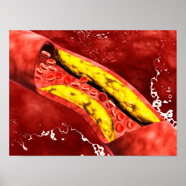 Póster Vista Microscópica De La Placa Grasa Dentro De La  (Frente)