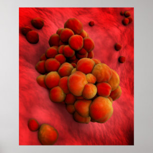 Póster Vista Microscópica Del Tumor 2