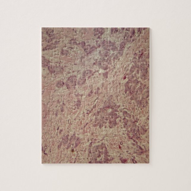 Puzzle Cáncer de pecho debajo del microscopio (Vertical)