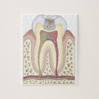 Ilustracion de la caries dental