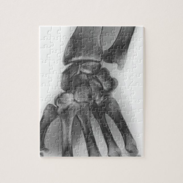 Puzzle muñeca normal, rayos X (Vertical)
