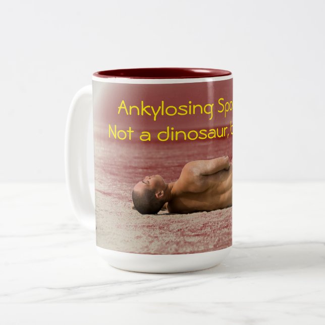 Spondylitis Ankylosing, no una taza del dinosaurio (Anverso izquierdo)