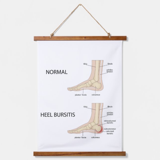 Tapiz Con Marco De Madera Bursitis alcaneal (Anverso)