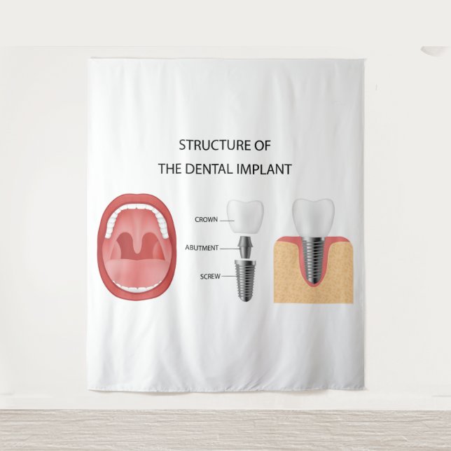 Tapiz Estructura del implante dental (Anverso)