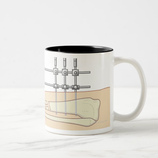 Taza Bicolor Fixator externo (Derecha)