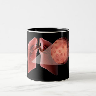 Taza Bicolor Vía aérea de Inflammed durante un ataque de asma