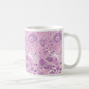 Taza De Café Células cancerosas del Taza-Pecho del café